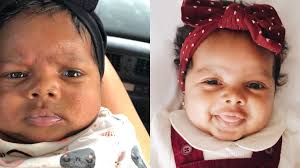 What to do when baby has acne? How To Get Rid Of Baby Acne Aseky Co