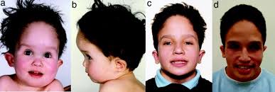 FG syndrome, an X-linked multiple congenital anomaly syndrome: The clinical  phenotype and an algorithm for diagnostic testing