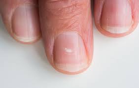 nail problems nhs