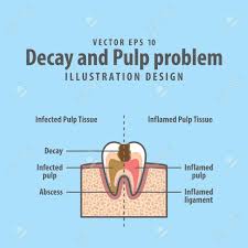 Decay And Pulp Problem Cross Section Structure Inside Tooth Diagram