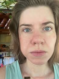 Help! Anyone know what this could be??? It started swelling half hour  ago!!?