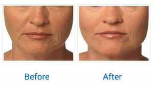 If you have a small or receding chin, this can make you look like a chipmunk, or a shark if it's really bad. Juvederm Ultra Ultra Plus And Voluma Patient Oc Dermatology