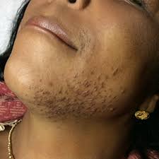 Over the years she noticed the number of hairs had if you want to feel the difference that laser hair removal before and after can make in your life, feel free to arrange a free consultation. Laser Hair Removal Before And After Pictures In Melbourne Fl Essentials Medispa Salon