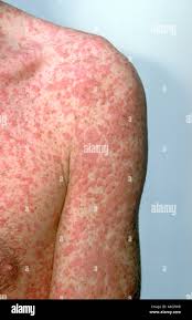 Image result for skin rash acute hiv infection