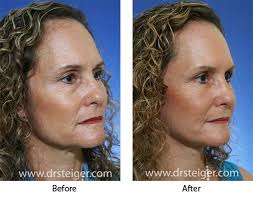 Full facelifts are typically expected to last around five years. Facelift Before And After Photos