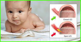Acid Reflux In Babies Causes Symptoms And Treatment Geburtszeit Com