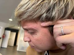 Tältä näyttää Williamin silmäkulma nyt