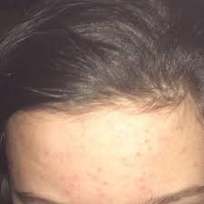 Was Hilft Gegen Diese Pickel Ich Halte Es Nicht Mehr Aus Madchen Haut Pubertat