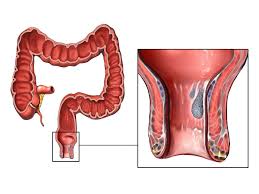 After the disease begins to spread, it can produce blood in the. Possible Causes Of Bloody Stool