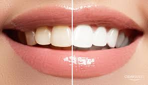 Teeth inevitably begin to yellow with age, but a range of strategies can slow the process and even reverse it. 5 Simple Ways To Naturally Whiten Your Teeth Clear Smiles Dallas Invisalign Provider