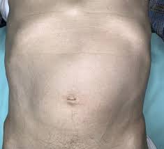 Image result for Splenomegaly