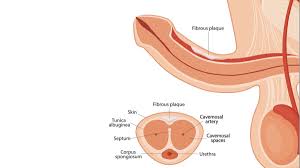 علاج انحناء القضيب او مرض بيروني في مركز دكتور أدهم زعزع