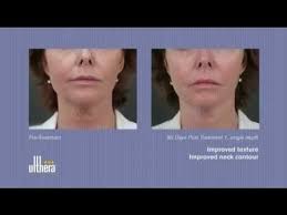 Laser facial vein treatment with Nd:YAG laser