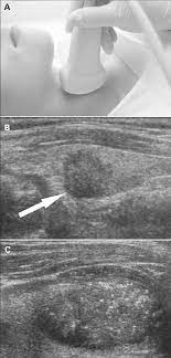 If you have a glass of water and a mirror, you're ready to look for symptoms of thyroid disorders. A Ultrasonography Of The Neck B Cancerous Nodule Detected On Download Scientific Diagram