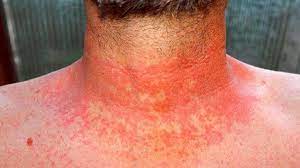 Most thyroid cancers are found at an early stage and can be treated successfully. Autoimmune Skin Diseases And Rashes That Affect Appearance Everyday Health