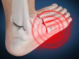 The joint damage manifests as decreased joint space, worn cartilage, and. Jones Fracture Causes Symptoms And Treatment