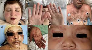 Lupus is an autoimmune disease. A Acute Cutaneous Lupus Butterfly Rash There Are Pink Patches Download Scientific Diagram