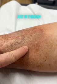 Image result for liver spots on legs