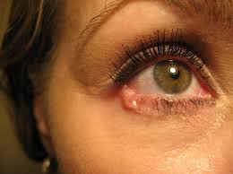 In children • episodes of severe pain, especially. Eye Cancer Symptoms