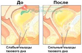 упражнения для укрепления мышц тазового дна при опущении матки Uprazhneniya Pri Opushenii Matki Gimnastika Zaryadka Lfk Po Kegelyu Yunusovu Atabekovu Joga V Kartinkah Video V 2020 G Tazovoe Dno Uprazhneniya Zaryadka