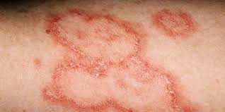 Systemic lupus erythematosus (sle) is a chronic inflammatory disease that has protean manifestations and follows a relapsing and remitting course. Things You Didn T Know About Lupus Prevention