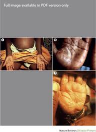 Image result for Primary Syphilis