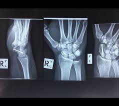 Image result for Scaphoid Bone