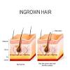 First Stage Ingrown Hair Genital Warts