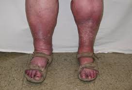 Image result for flegmona pedis)