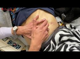 Image result for Shifting Dullness Test