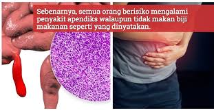 Saya juga mengamalkan vitamin selepas pembedahan untuk jadikan luka selepas pembedahan kering dan pulh dengan cepat. Betul Ke Biji Cili Boleh Jadi Punca Sakit Apendiks Ini Penjelasan Dari Pakar