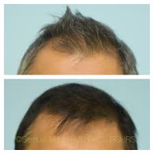 Hair loss in women can be absolutely devastating for self image and. This 40 Year Old Gentleman Is Shown Before And 6 Months After Starting Topical Finasteride With Improvement In His Hair Lo Dallas Hair Hair Restoration Topical