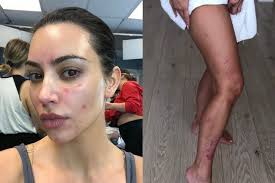 Normalmente, il sistema immunitario va a colpire elementi il lupus è una malattia autoimmune che prevede l'attivazione del sistema immunitario contro il corpo se avete notato la comparsa di macchie rosse sulla pelle senza prurito , vi starete certamente chiedendo. Kim Kardashian E La Lotta Contro Lo Psoriasi Sui Social Rivela Le Macchie Rosse Sulla Pelle