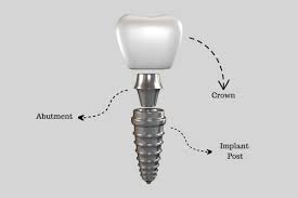 Image result for dental implant
