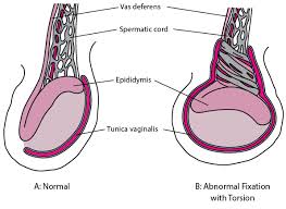 Testicular cancer is the most common cancer in men ages 20 to 35, but highly treatable if caught early. Testicular Torsion Genitourinary Disorders Merck Manuals Professional Edition