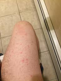 Common culprits of red bumps it's not likely that you panic when you spot red bumps on your legs. My Upper Leg Has Red Dots Along It I Want Them Gone Anyone Have Success With This Acne
