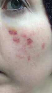 Treatment for purpura usually requires treating the rash's underlying cause. Bruising After Purpura Laser Treatment Photos