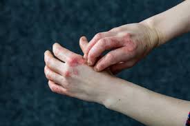 Image result for contact dermatitis