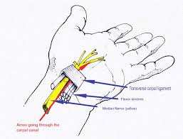 Carpal Tunnel Syndrome
