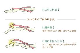 指の捻挫、突き指 - 岐阜市 - 森整形外科リハビリクリニック