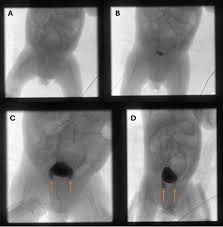 Image result for Voiding Cystourethrogram