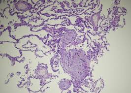 Das krankenhaus übernimmt, neben der klinik favoriten. Organizing Pneumonia Following Covid19 Pneumonia Springerlink