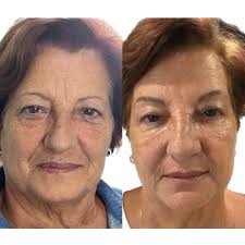 Lunes con L de labios 👄 Porque solo pequeños detalles 🫦 realzan la  belleza de mis pacientes 🔥🔥🔥 Gracias @stephanyacs por la confianza y por  dejarme publicar tus fotos 😍 #dravalentinaangulo