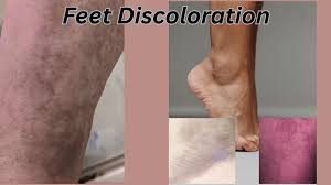 Image result for brown patches on the feet