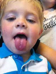 Hemophilia family, I have two children, hemophilia A, the first is severe,  and my second son is hemophilia A at 2%. He was diagnosed at 1 month old  and is now 5