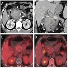 For this reason, wait time and scan times for mri are much longer than ct. A 59 Year Old Male Mfcp Patient With Upper Abdominal Pain For 12 Days Download Scientific Diagram