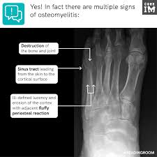 Image result for Osteomyelitis XRay