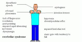 Image result for Cerebellar Function Test