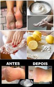 Calcio E Oil Antes E Depois Dermatologistas Estao Surpresos Porque Este Remedio Elimina Calos Calos Fungos Nos Pes Esfoliantes Caseiros