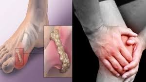 Cara mengobati asam urat tidak cukup hanya dengan obat dari dokter. Bolehkah Asam Urat Makan Kuaci Bunga Matahari Info Lif Co Id